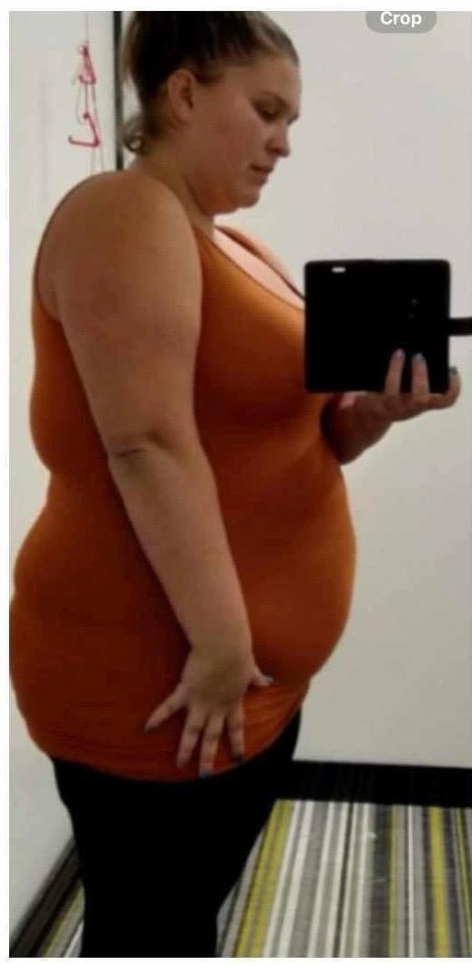 Emma before GLP-1 treatment